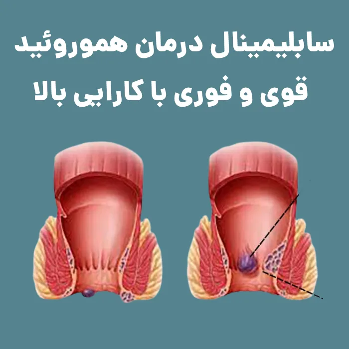 سابلیمینال درمان هموروئيد